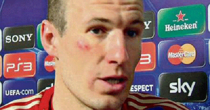 Robben bị sưng dưới mắt